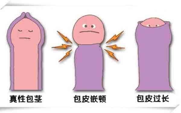 我想割包皮,请问包皮手术疼么?