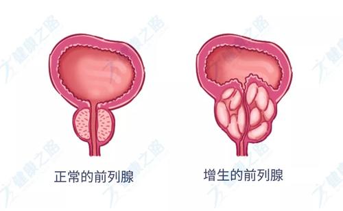 前列腺增生症状,前列腺增生危害,前列腺增生治疗,前列腺炎手术
