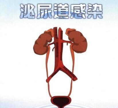 泌尿系统,泌尿系统感染症状,泌尿系统治疗,泌尿系统感染危害,泌尿系统感染